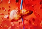 Fatty Liver Disease: Causes, Symptoms & Treatments Explained