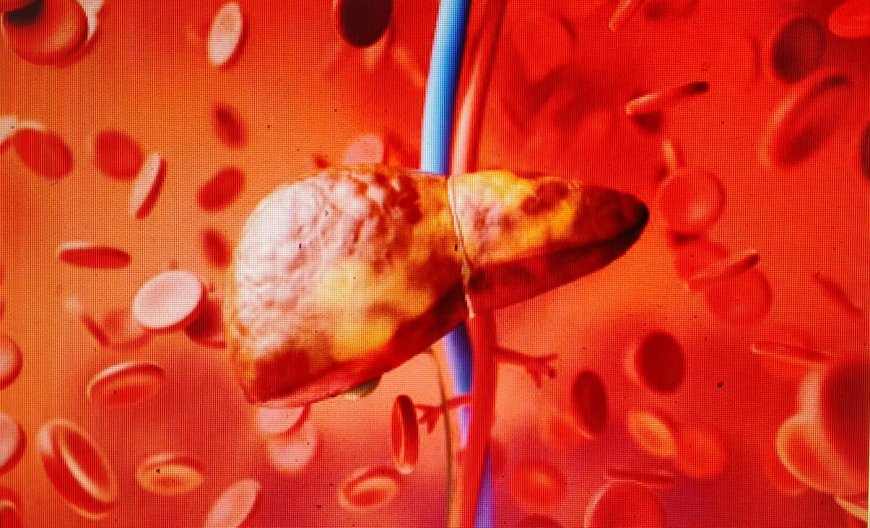 Fatty Liver Disease: Causes, Symptoms & Treatments Explained
